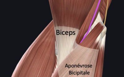 Opération pour un syndrome du Lacertus