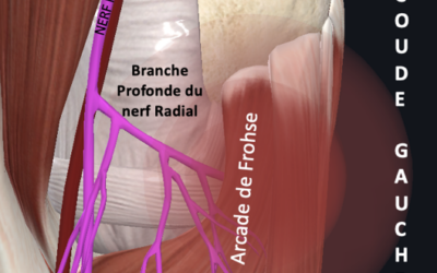 Syndrome du Tunnel Radial (STR)