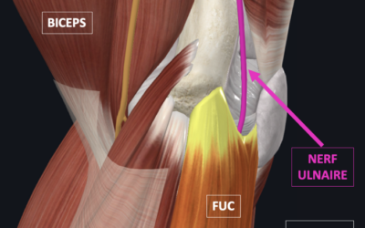 Syndrome du Tunnel Cubital (STC)